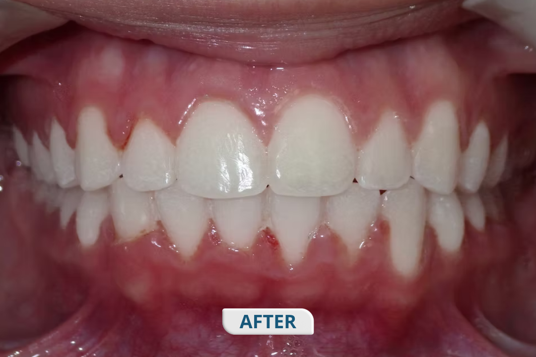 After treatment at Namira Oro Dental Care